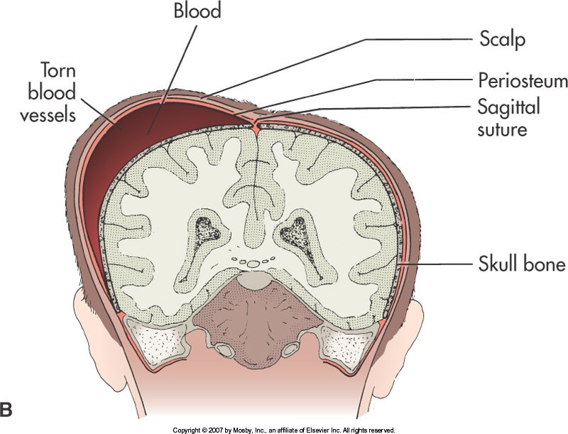 Cephalohematoma Elsevier.jpg